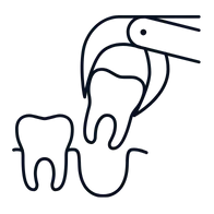 tooth extraction