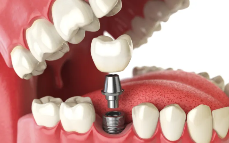 dental implants