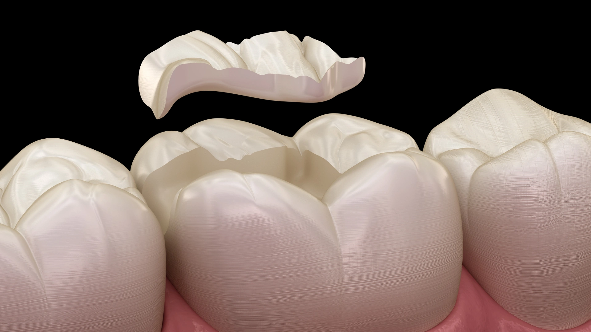 dental sealants in dallas