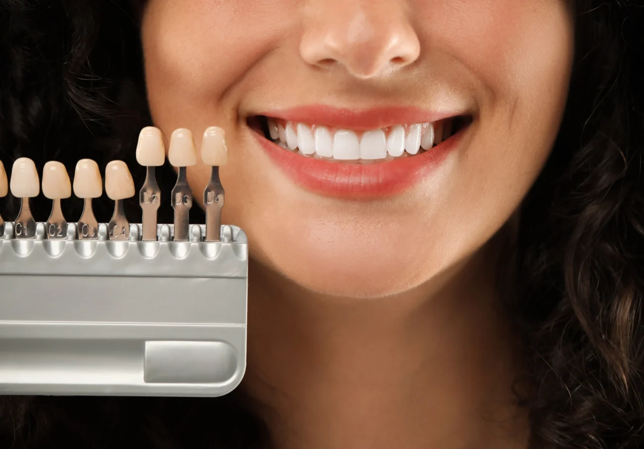 porcelain veneers