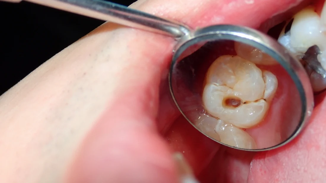 tooth decay in dallas