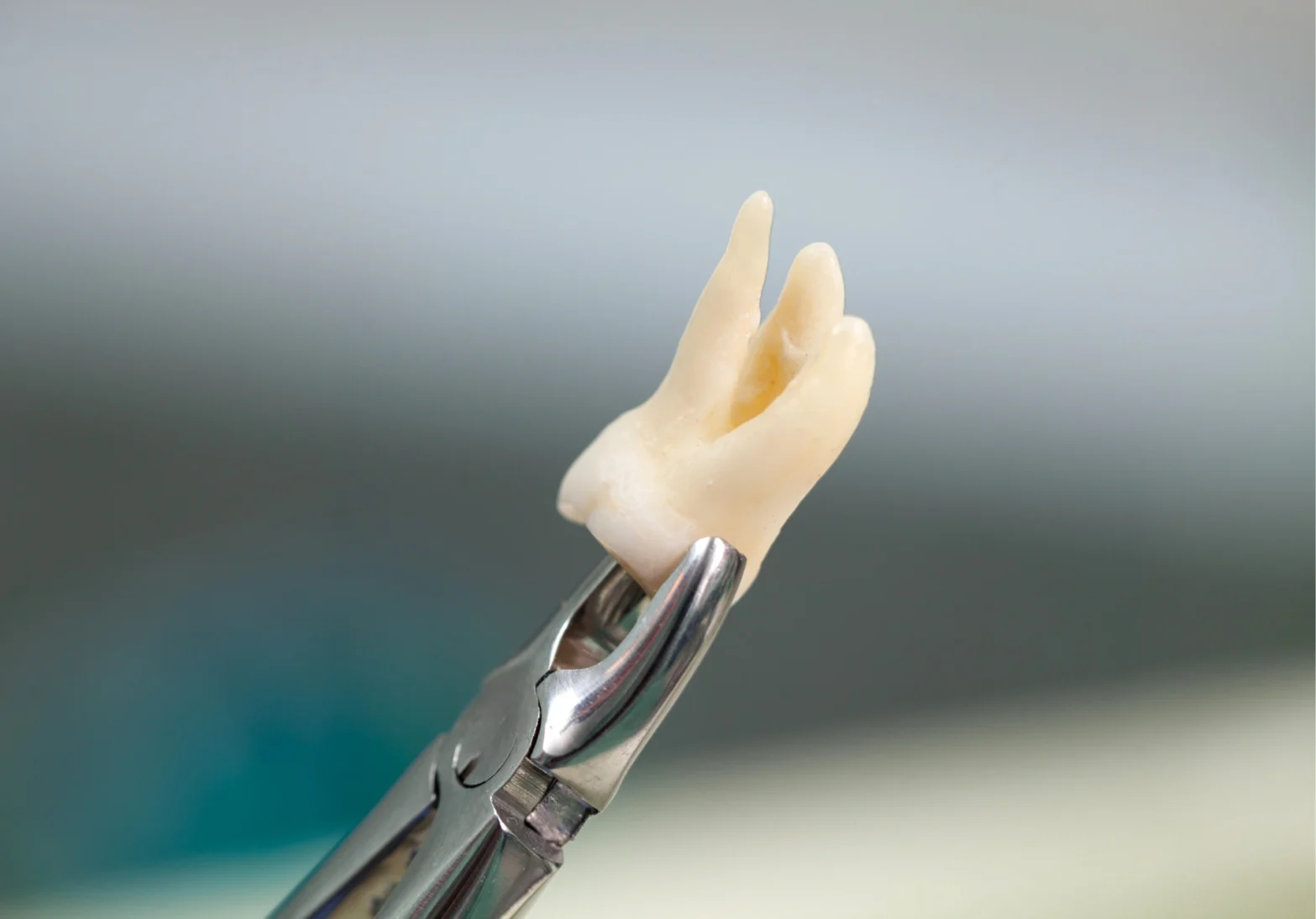 tooth extraction