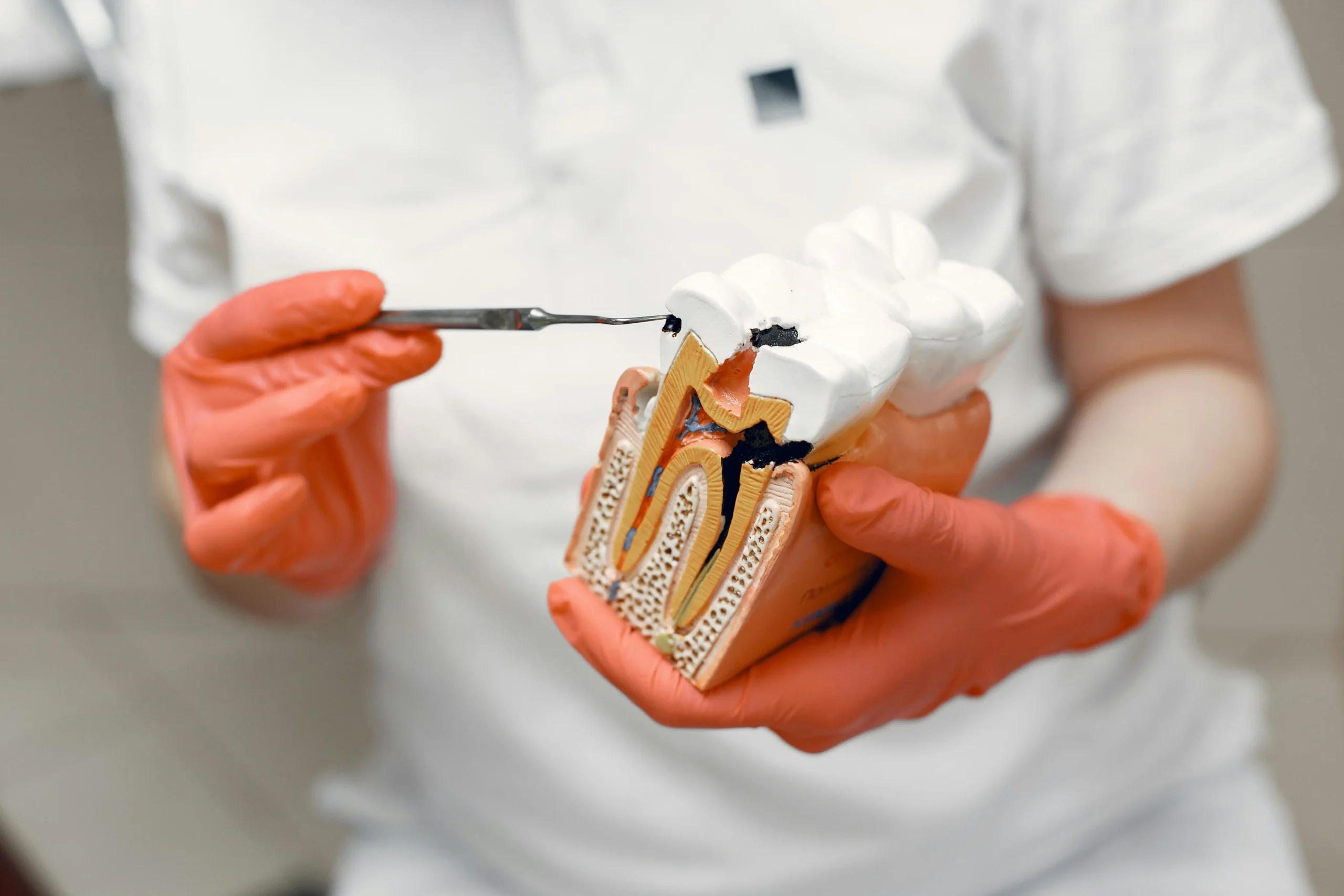 Dental professional holding a tooth model to explain exposed tooth roots and decay damage