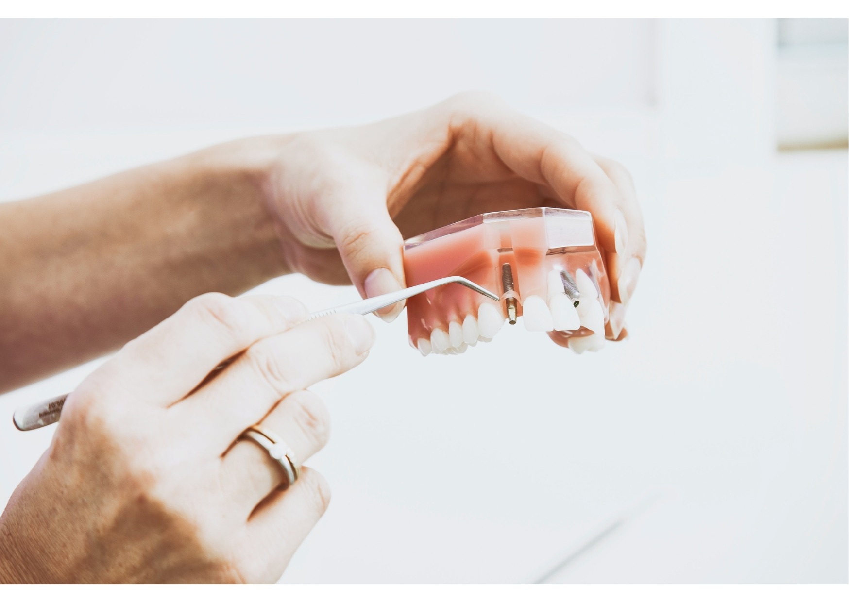 Dental implant model used to explain the cost of dental implants and implant-supported tooth replacement