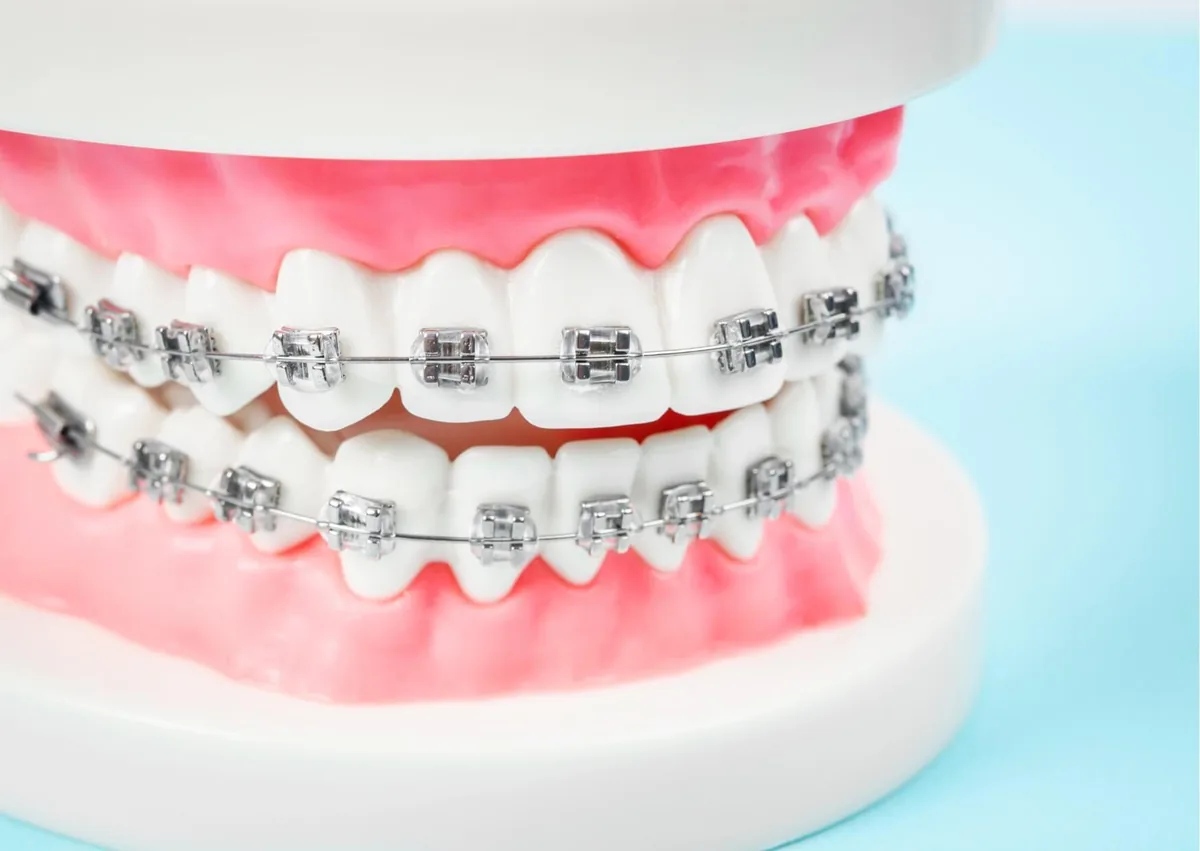 Dental model with traditional metal braces illustrating factors related to braces cost.