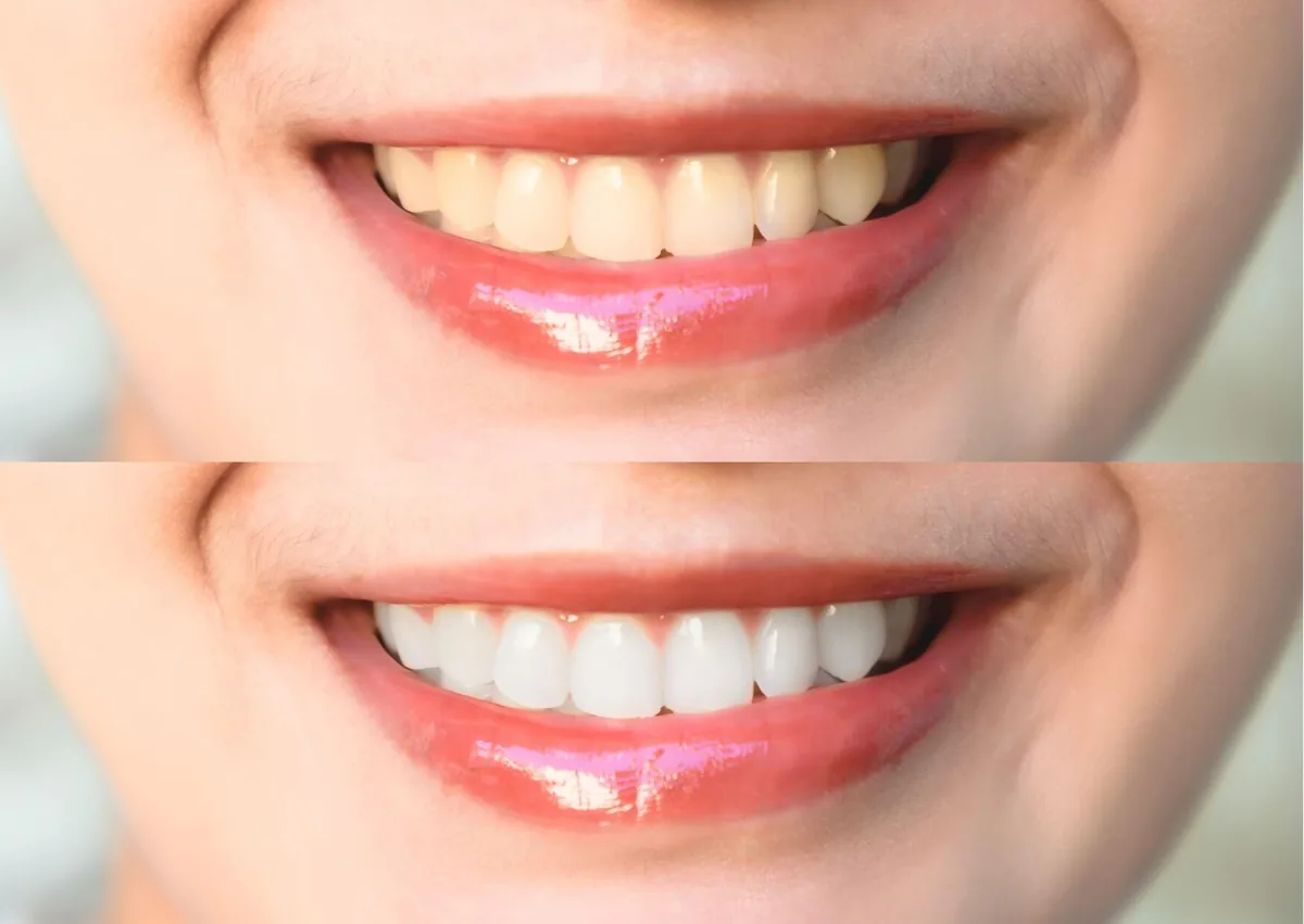Before-and-after view of a brighter, more even smile illustrating possible smile makeover results.