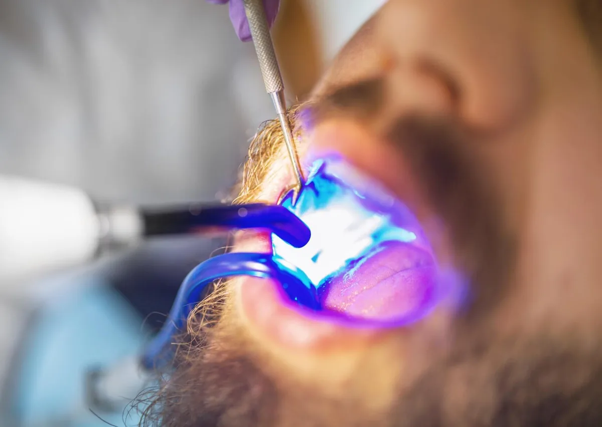 Dental sealant being applied to a patient&rsquo;s teeth as part of preventive care and dental sealants cost considerations.