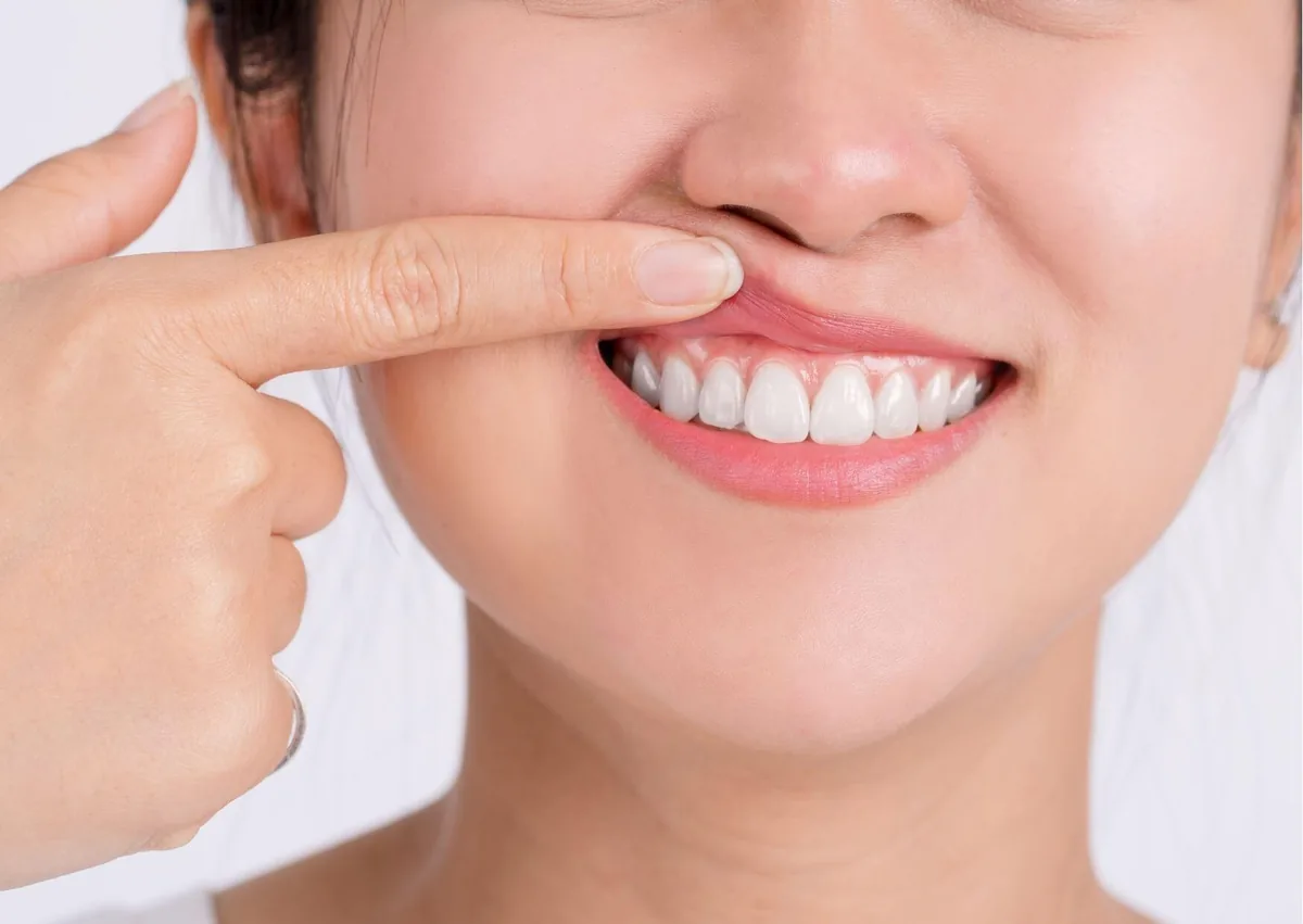 Close-up of a patient showing the gumline before or after gum contouring treatment.