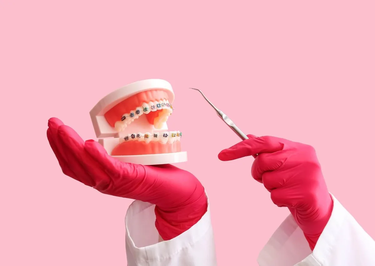 Dental model with metal braces used to explain braces cost with insurance and orthodontic treatment options.